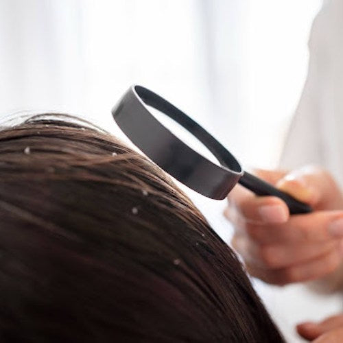 Can dandruff cause hair loss