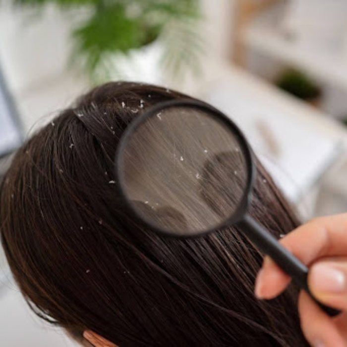 Types of dandruff