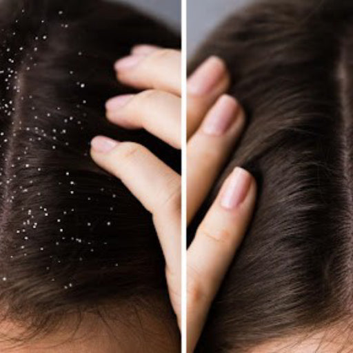 Dandruff Occurs