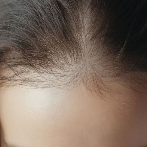 Female Pattern Baldness
