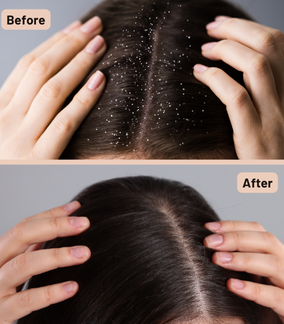 hair scalp before after result