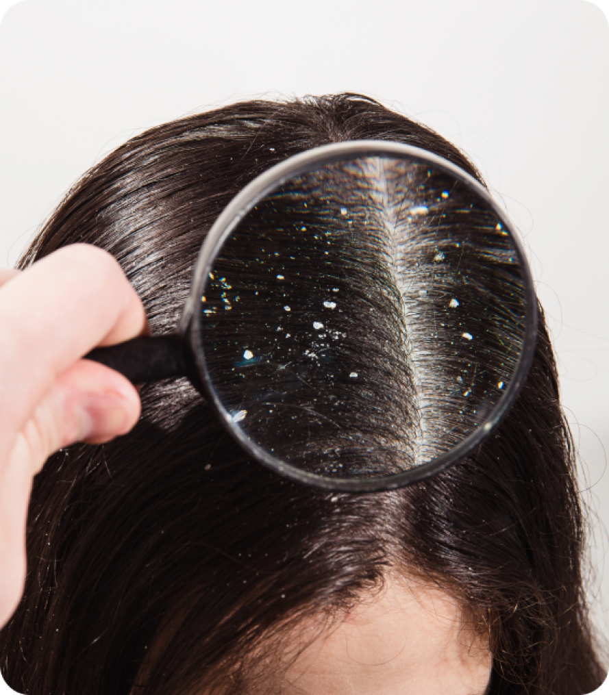 best way to control dandruff